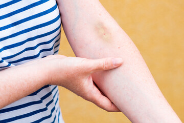 Vein hematoma on female hand after phlebotomy