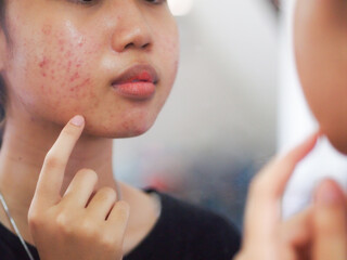 Teenage asian girl looking into the mirror to check the acne problem on her face.