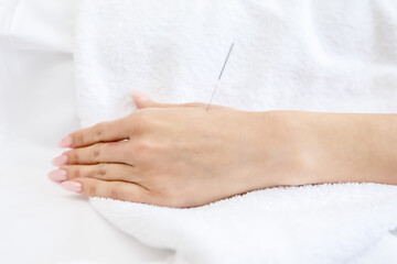 patient receiving acupuncture procedure, close-up - obrazy, fototapety, plakaty