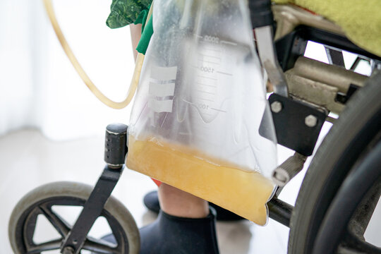 Asian lady woman patient sitting on wheelchair with urine bag in the hospital ward, healthy medical concept