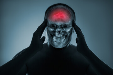 X-ray of a man's head. Cerebral stroke. Brain damage is highlighted by red colour.
