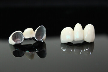 Porcelain fused to metal. PFM bridge