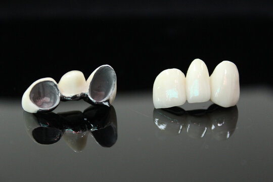 Porcelain fused to metal. PFM bridge