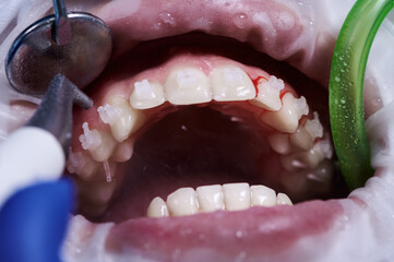 Close up of periodontist using dental tools while cleaning teeth of patient, with cheek retractor...
