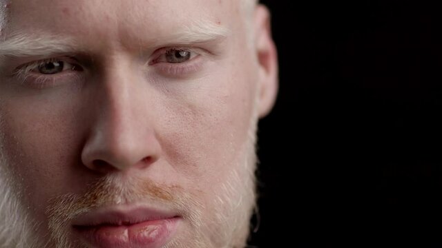 Albino Man Looking At Camera Posing On Black Background, Closeup