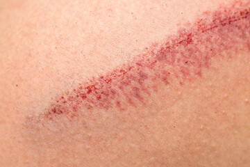 Fototapeta premium large deep scratch on the skin