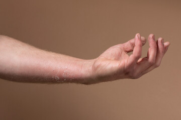 Fototapeta premium Sunburnt peeling skin on a damaged mans arm. A painful dry injured cracked part of the body healing from too much uv light without sun protection