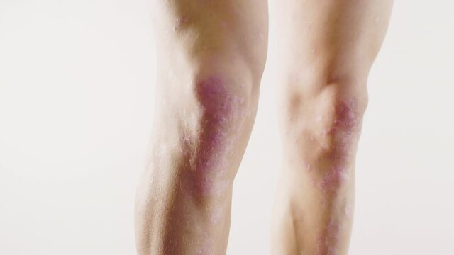 homme, psoriasis, ecz&eacute;ma, probl&egrave;me de peau, m&eacute;dicale, corps, femme, nu, sein, beaut&eacute;, jeune, beau, peau, torse, poitrine, sant&eacute;, blanc, mod&egrave;le, fitness, musculaire, mince, isol&eacute;, sain, arri&egrave;re, main, 