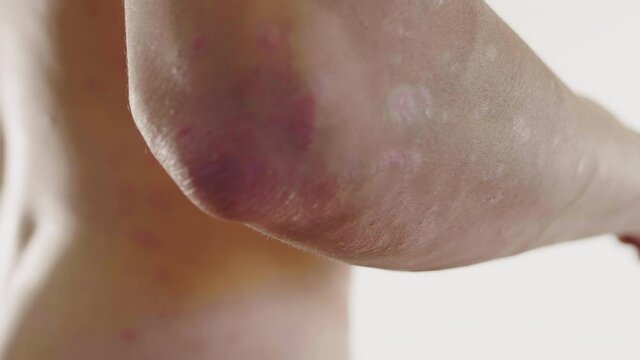 homme, psoriasis, ecz&eacute;ma, probl&egrave;me de peau, m&eacute;dicale, corps, femme, nu, sein, beaut&eacute;, jeune, beau, peau, torse, poitrine, sant&eacute;, blanc, mod&egrave;le, fitness, musculaire, mince, isol&eacute;, sain, arri&egrave;re, main, 