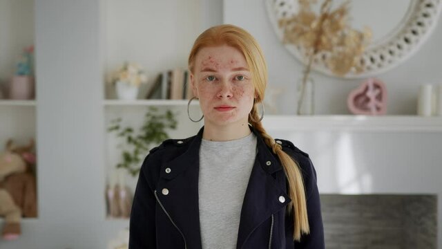 Montage of Young Beautiful Redhead Girl with Problem Skin Looks at the Camera Like in a Mirror. 28 Days Acne treatment time lapse. Woman skin care concept. Clean Platte Added.