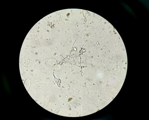 Fungal Yeast, Budding yeast and pseudohyphae of Candida albicans, stained with periodic acid-Schiff...