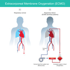 Extracorporeal membrane oxygenation. diagram for explain rescue patients respiratory failure by using instrumental  extracorporeal membrane oxygenation ECMO..