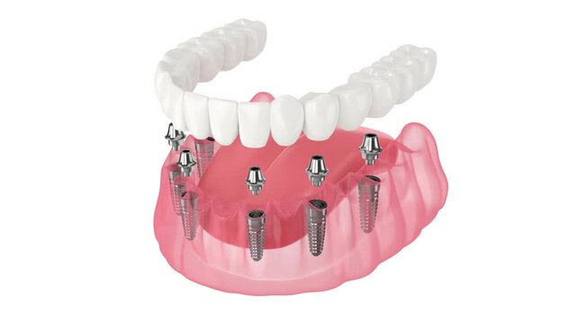 Mandibular prosthesis all-on-6 system supported by implants