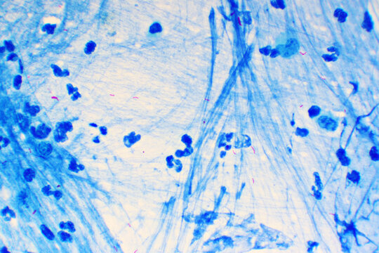 Mycobacterium tuberculosis positive (small red rod) in sputum smear, acid-fast stain, analyze by microscope 1000x