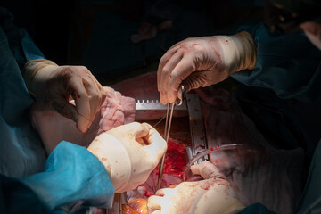 coronary artery bypass graft operation (CABG). Surgery for Coronary Artery Bypass Grafting: CABG....
