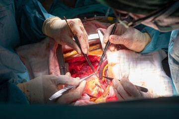coronary artery bypass graft operation (CABG). Surgery for Coronary Artery Bypass Grafting: CABG....