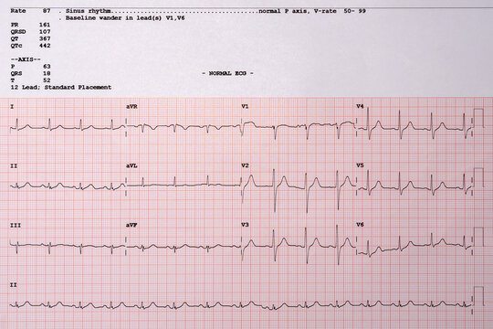 Images charts scientific cardiograms, and mathematical calculations from patients. Heart pulse or Heart wave, graph on paper.(Electrocardiography: ECG)