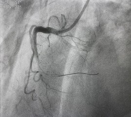 coronary angiogram shown massive thrombus that occluded right coronary artery (RCA) in patient with...