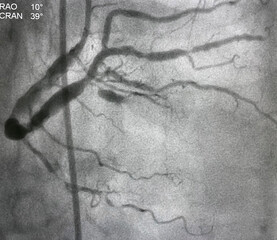 coronary angiogram shown massive thrombus that occluded right coronary artery (RCA) in patient with...