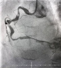coronary angiogram shown massive thrombus that occluded right coronary artery (RCA) in patient with...