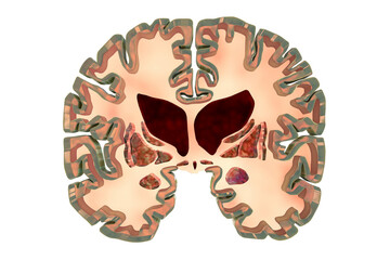 Coronal section of a brain of a person with Huntington's disease