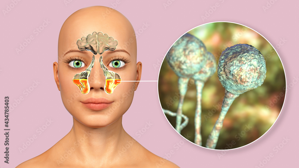 Sticker Mucor fungi as a cause of sinusitis, 3D illustration