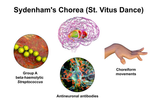 Sydenham's chorea, an autoimmune disease that results from childhood infection with Streptococcus bacteria