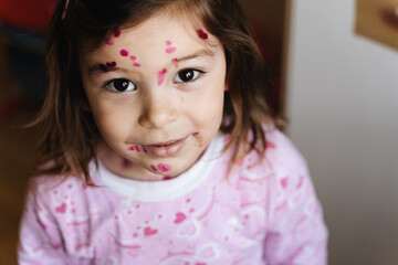 Obraz na płótnie Canvas Toddler girl with chickenpox measles on the body. Varicella virus childhood contagious disease. Itchy red blisters, fever, pain symptoms. 