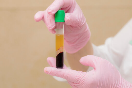 A test tube with blood plasma in the hand of a specialist. Plasmolifting, medical cosmetology.