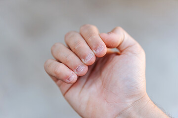 A man's hand with bitten and ugly fingernails. Bad care of hands