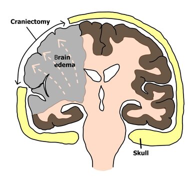 Craniectomy is the neurological operatipon to save life of ischemic stroke patient.