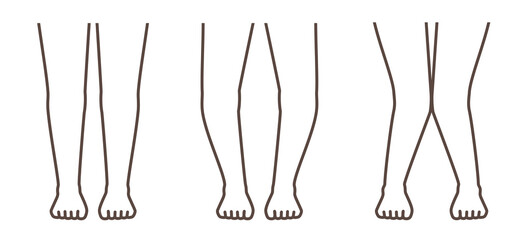 変形性膝関節症　図解