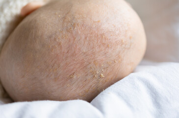 seborrheic crusts or flakes on infant baby's head macro view