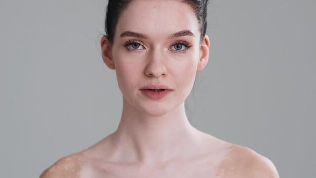 Vitiligo Treatment Images – Browse 3,222 Stock Photos, Vectors, and