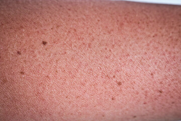 Fototapeta premium The skin of the hand burnt in the sun. Reddened skin of a woman's hand. Close-up sunburn of the skin.