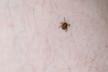 A tick on the human body.