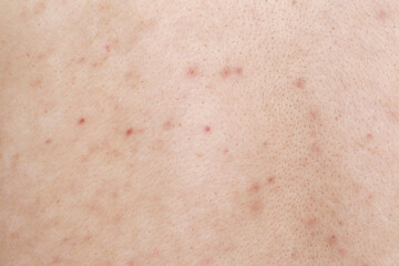 Health problem, skin diseases. Man showing his back with acne, red spots.Acne on the back