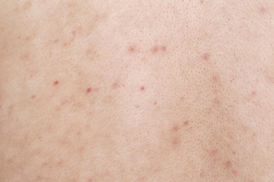 Health problem, skin diseases. Man showing his back with acne, red spots.Acne on the back