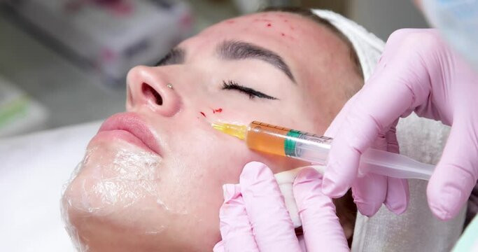 The doctor gives injections of blood plasma into the face of a young girl. Therapeutic procedure, plasmolifting