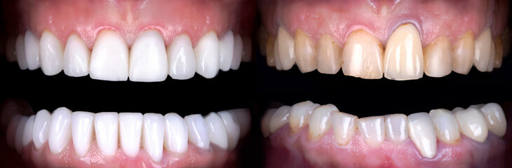 Perfect smile whitening before and after veneers bleach of zircon arch ceramic prothesis . Implants...