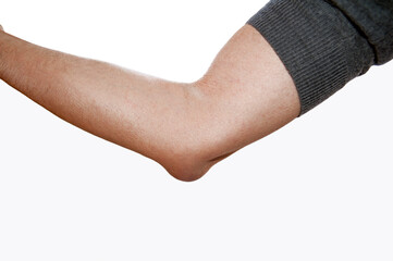 Arm of a man with olecranon bursitis at the tip of his elbow.