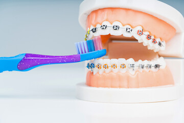 Orthodontics treatment and care. Orthodontic model and dentist tool - demonstration teeth model of...