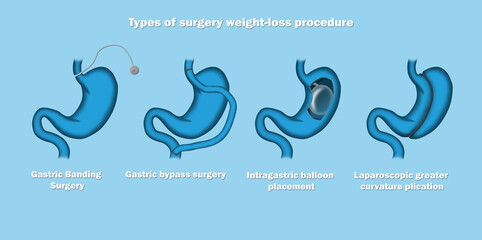 Types of surgery weight loss procedure. - obrazy, fototapety, plakaty