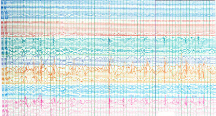 Photography of brain waves  of epileptic patient showing sharp wave during  no seizure or...