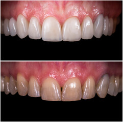 teeth treatments with crowns and venners