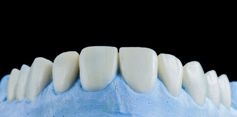 teeth treatments with crowns and venners