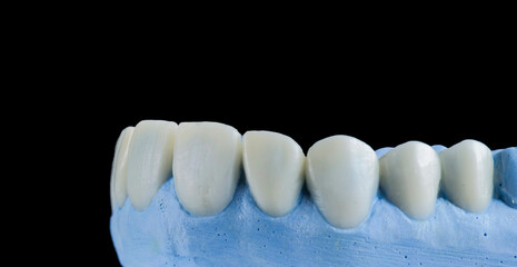 teeth treatments with crowns and venners