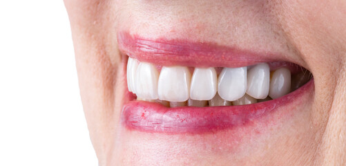 Obraz premium teeth treatments with crowns and venners