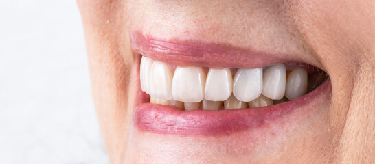 Fototapeta premium teeth treatments with crowns and venners