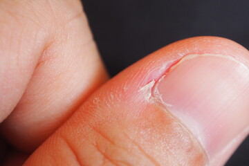 Closeup of deformed nails and skin peeling off from human nail biting behavior Medical and healthcare concept 